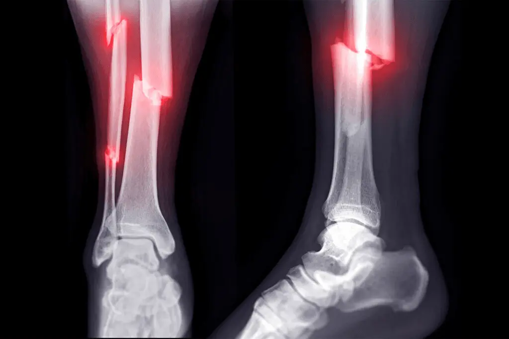 x-ray of leg fracture